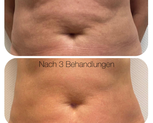 DermWave™ Pro Bauch