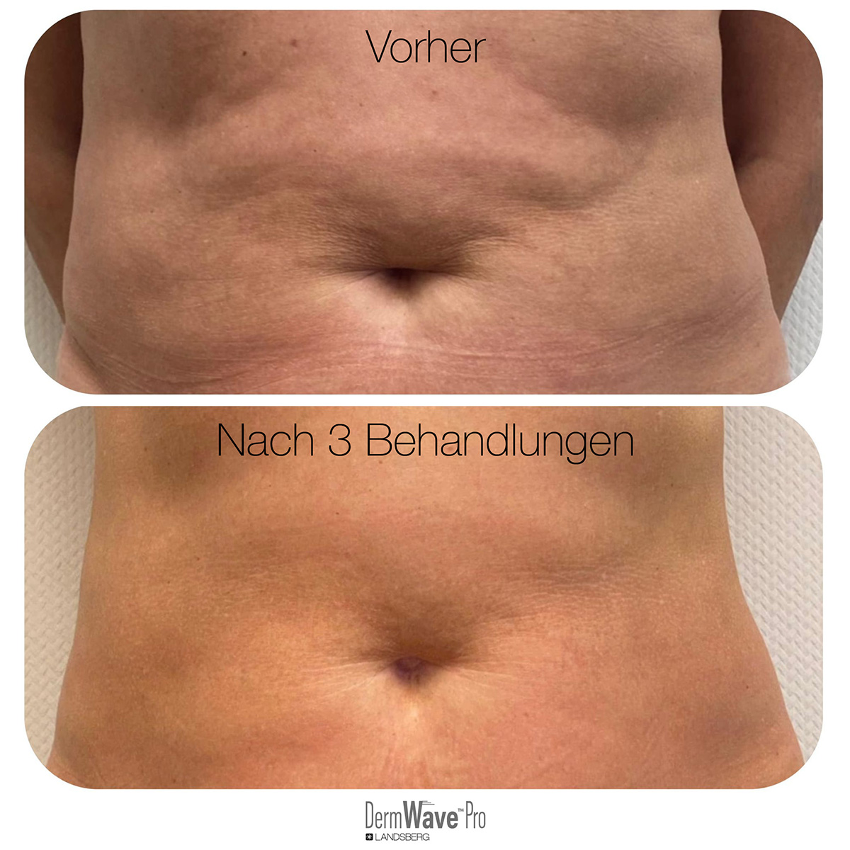 DermWave™ Pro Bauch