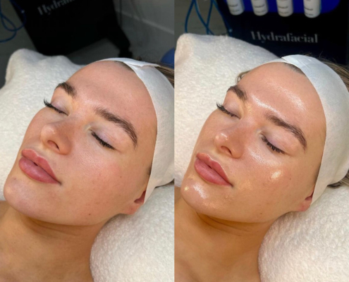 HydraFacial™ Gesicht