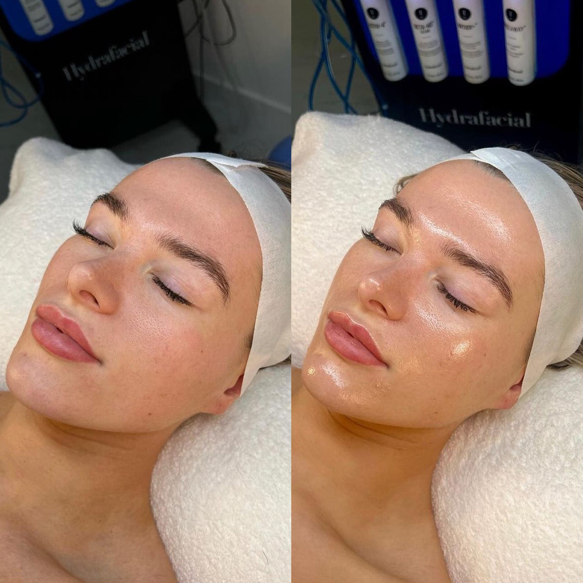 HydraFacial™ Gesicht